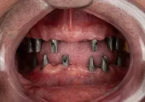 Before full arch implant treatment, full mouth missing teeth, Angela Leung DDS PC South San Francisco Before full arch implant treatment, full mouth missing teeth, Angela Leung DDS PC South San Francisco